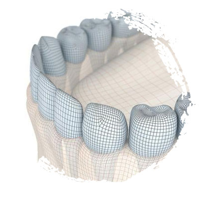 Имплантация All-on-4