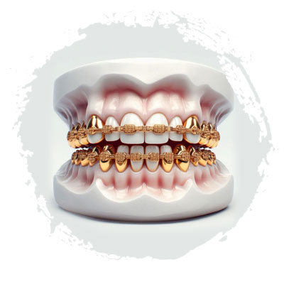 Установка брекетов