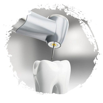 Лечение зубов